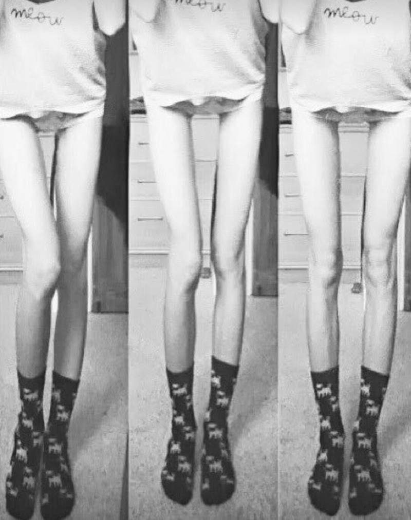 Очень худые ноги анорексия